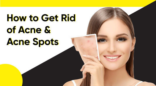 How To Get Rid Of Acne & Acne Spots
