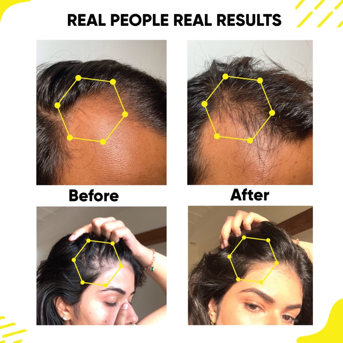 Masofta Hair Growth Serum Real People Results