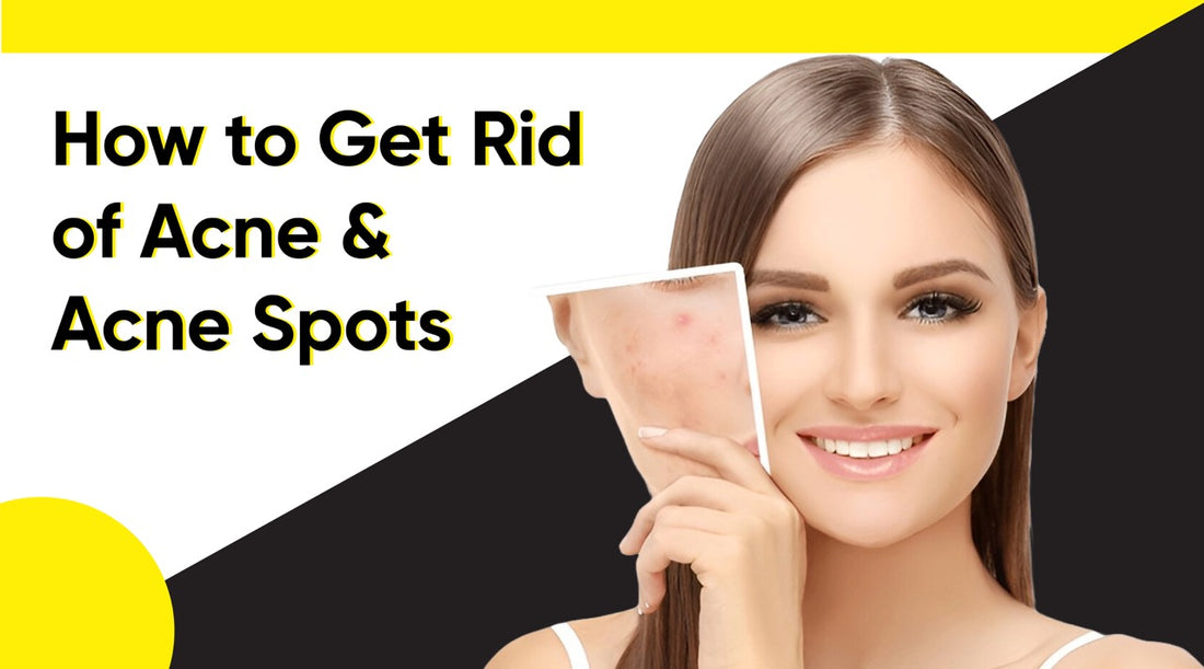 How To Get Rid Of Acne & Acne Spots