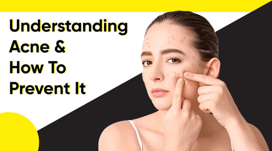 Understanding Acne and How to Prevent It