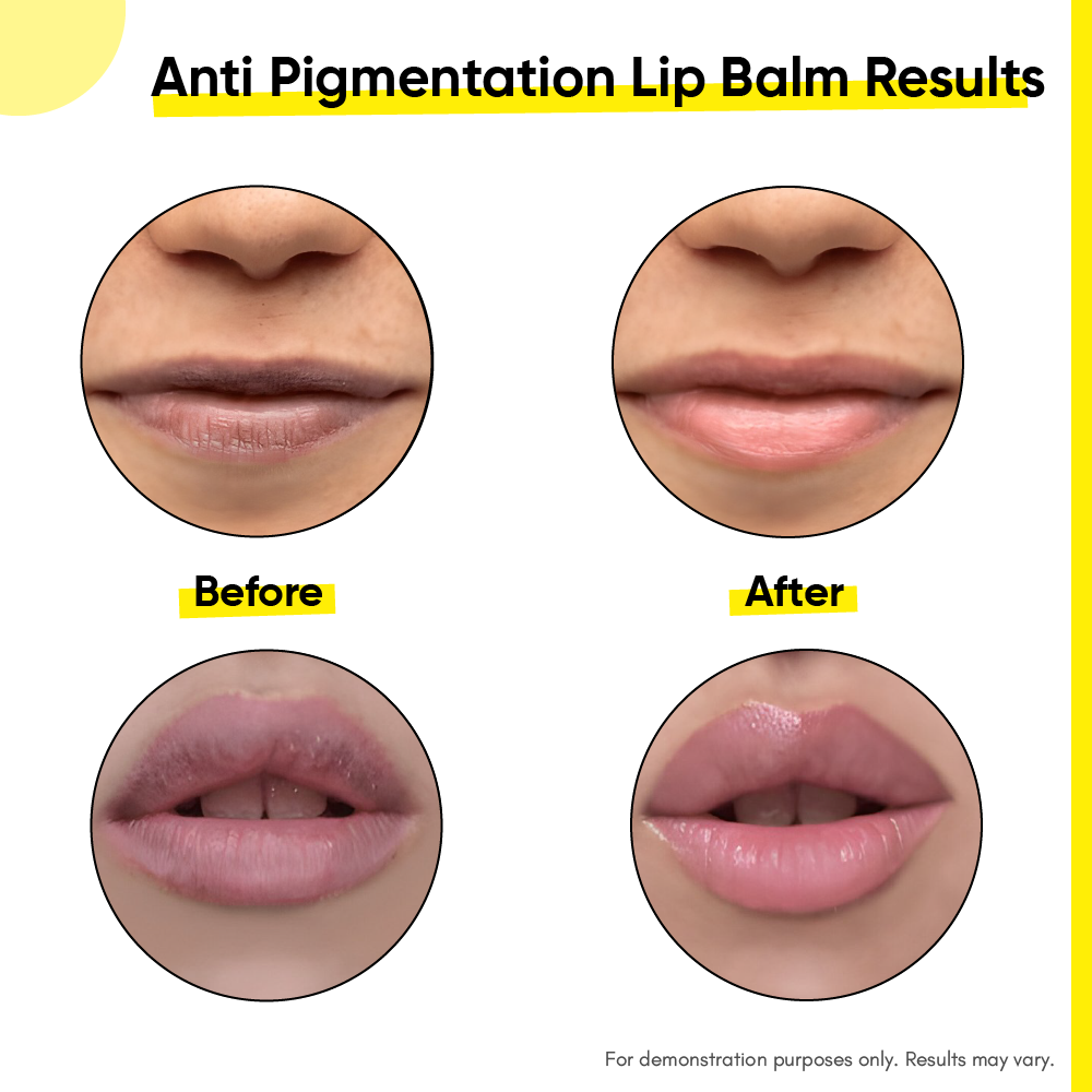 Anti pigmentation lip balm before after results