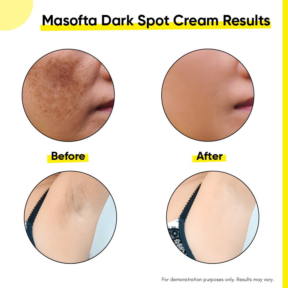 Masofta dark spot reduction cream before after results