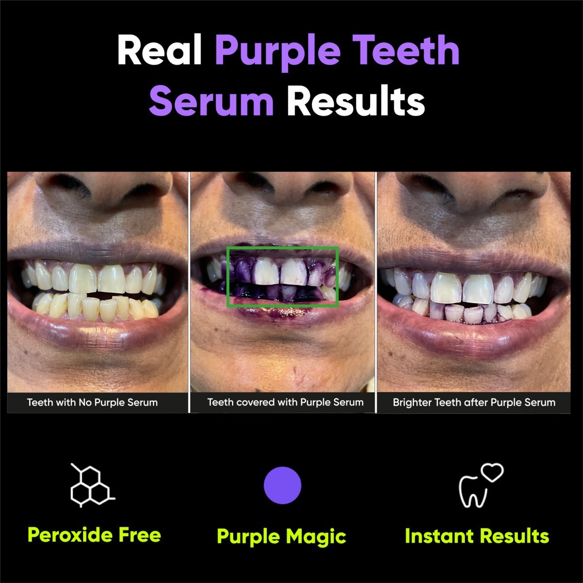 Purple Teeth Whitening Serum Results